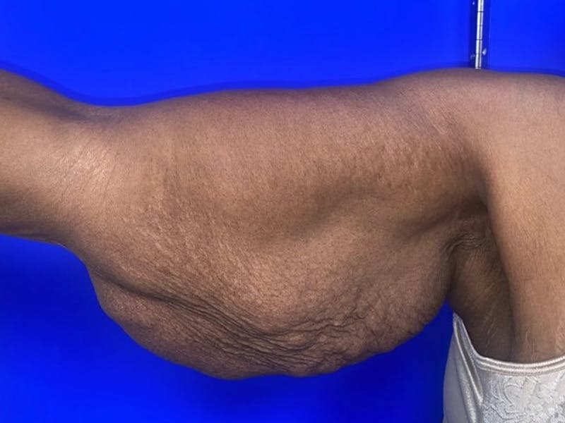 Arm Lift Before & After Gallery - Patient 122659 - Image 5