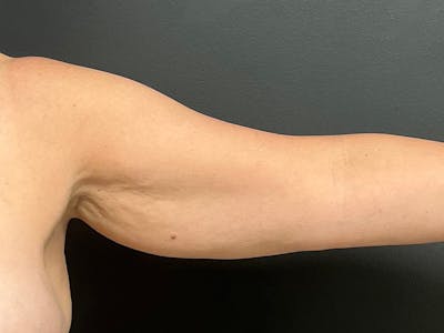 Arm Lift Before & After Gallery - Patient 460783 - Image 1