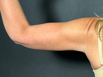 Arm Lift Before & After Gallery - Patient 298268 - Image 1