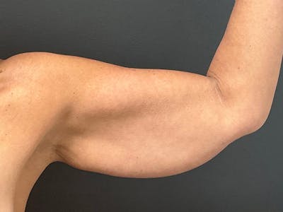 Arm Lift Before & After Gallery - Patient 126876 - Image 1