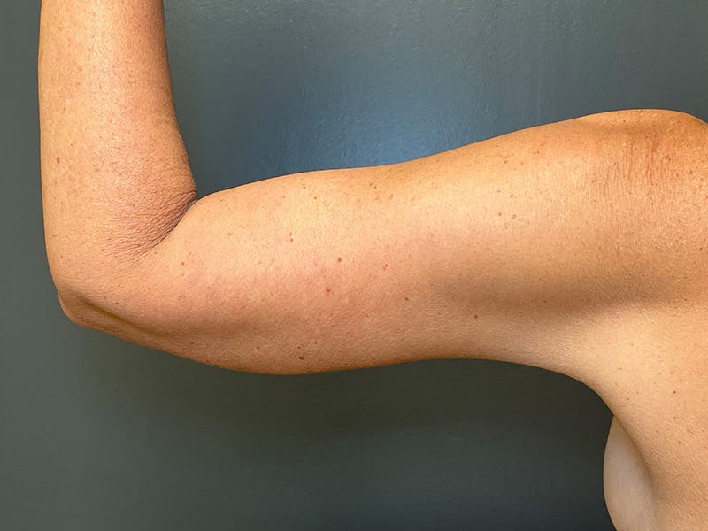 Arm Lift Before & After Gallery - Patient 126876 - Image 6