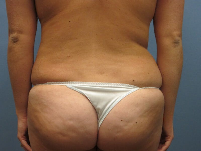Back Before & After Gallery - Patient 907716 - Image 2