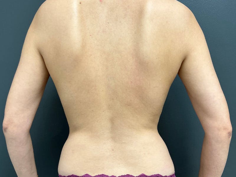 Back Before & After Gallery - Patient 166545 - Image 1