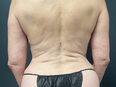 Back Before & After Gallery - Patient 277717 - Image 2