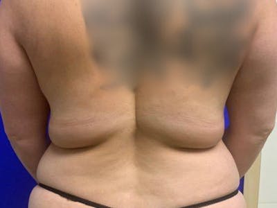 Back Before & After Gallery - Patient 377734 - Image 1