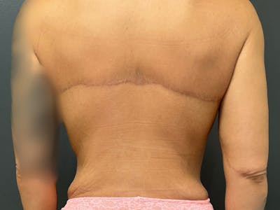 Back Lift Before & After Gallery - Patient 317434 - Image 2