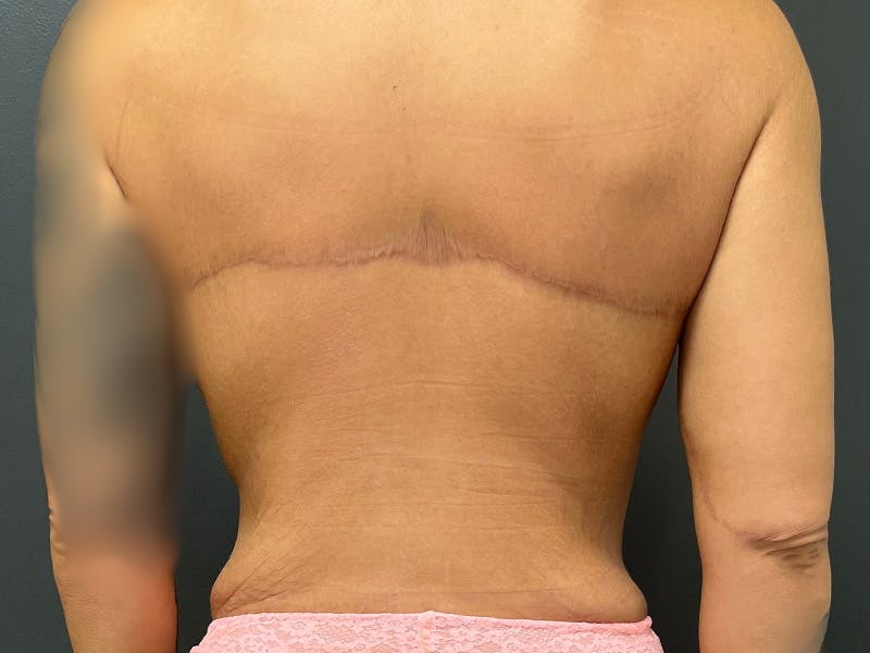 Back Lift Before & After Gallery - Patient 317434 - Image 2