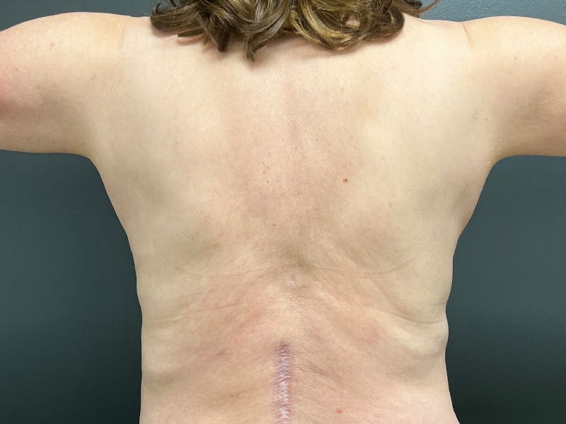 Back Lift Before & After Gallery - Patient 368284 - Image 3