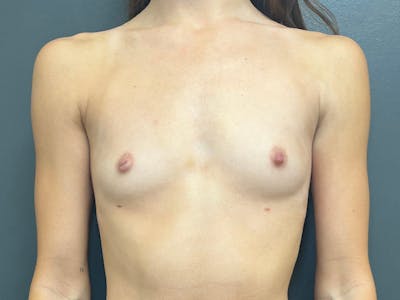 Breast Augmentation Before & After Gallery - Patient 940468 - Image 1