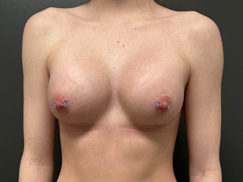 Breast Augmentation Before & After Gallery - Patient 251186 - Image 2