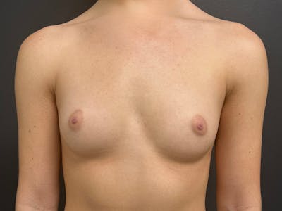 Breast Augmentation Before & After Gallery - Patient 429014 - Image 1