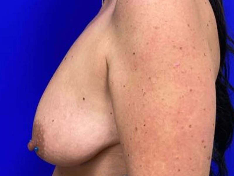 Breast Augmentation with Lift Before & After Gallery - Patient 114025 - Image 5