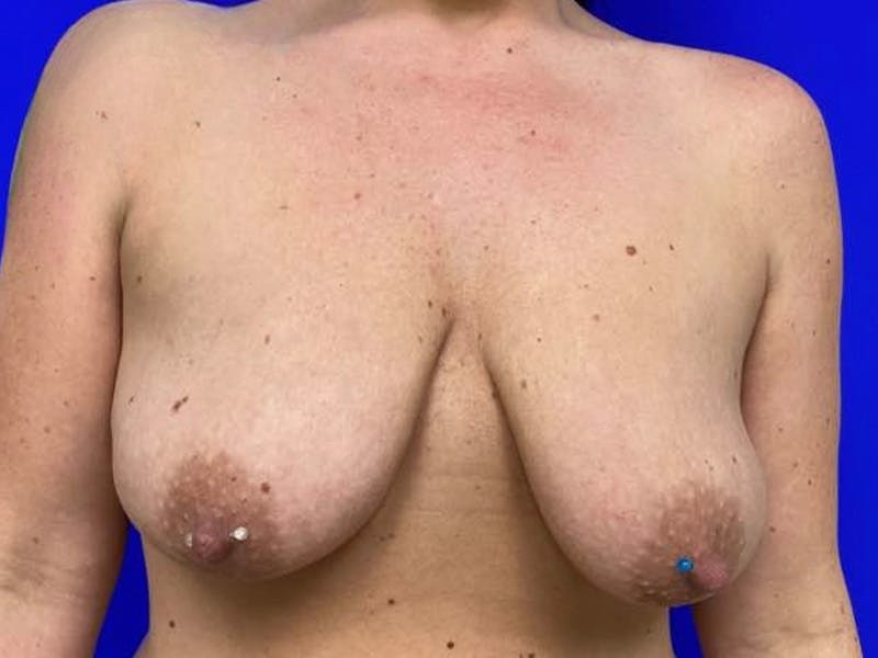 Breast Augmentation with Lift Before & After Gallery - Patient 114025 - Image 1