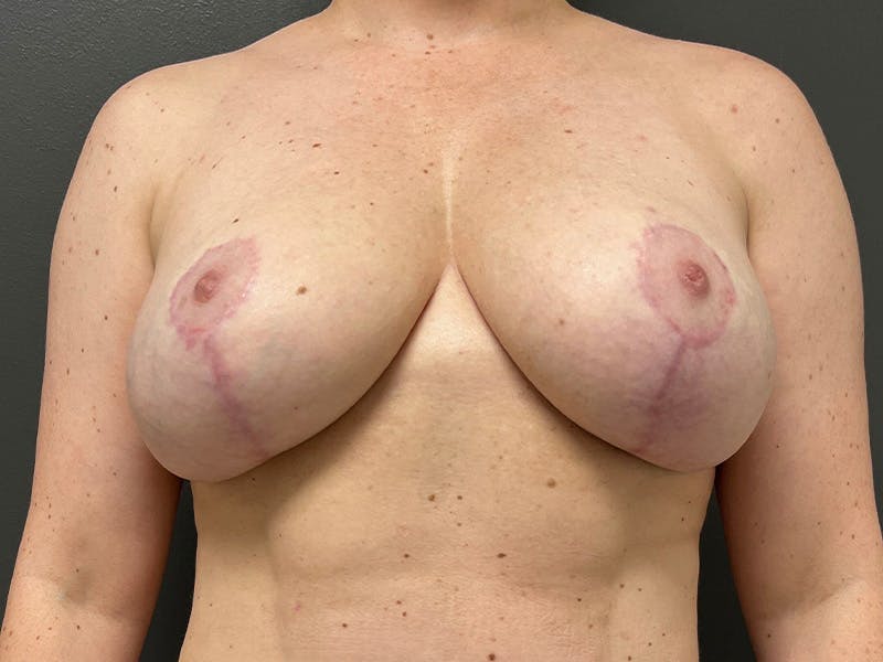 Breast Fat Grafting Before & After Gallery - Patient 125861 - Image 2