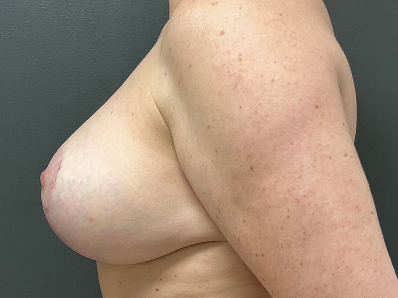 Breast Fat Grafting Before & After Gallery - Patient 125861 - Image 10