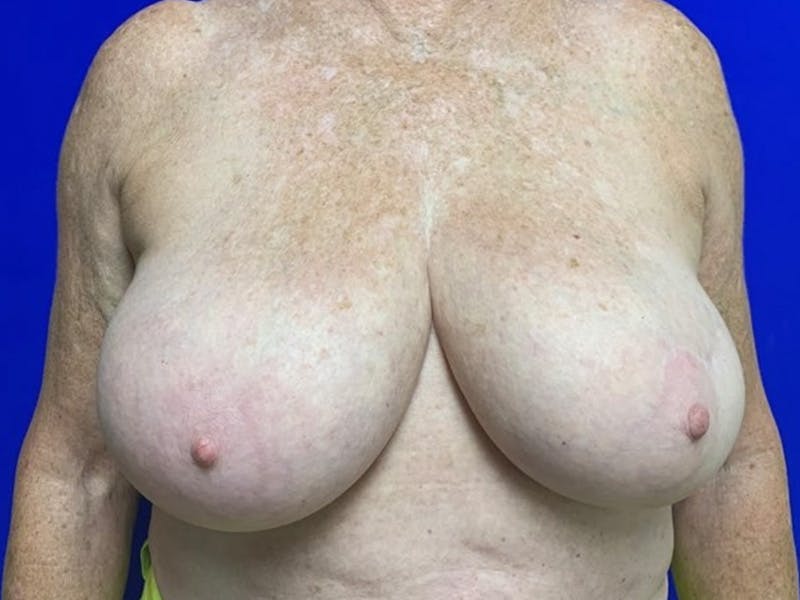 Breast Reconstruction Before & After Gallery - Patient 265807 - Image 1