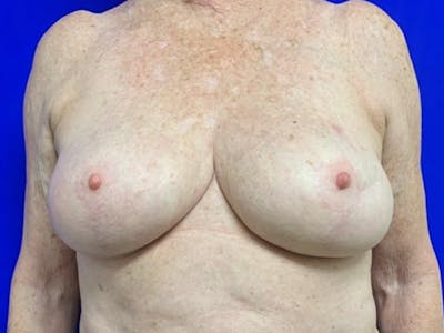 Breast Reconstruction Before & After Gallery - Patient 265807 - Image 2