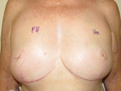Breast Reconstruction Before & After Gallery - Patient 304817 - Image 2