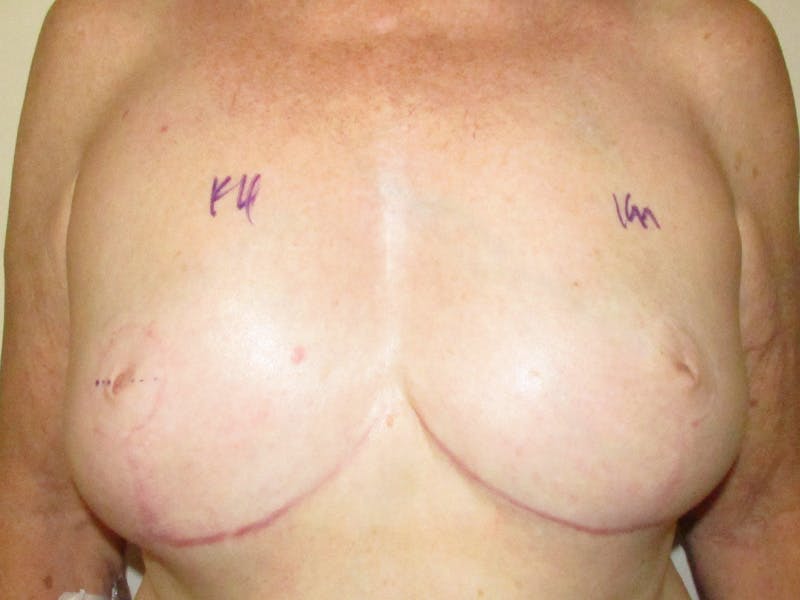 Breast Reconstruction Before & After Gallery - Patient 304817 - Image 2