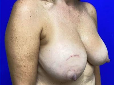 Breast Reduction Before & After Gallery - Patient 419400 - Image 1