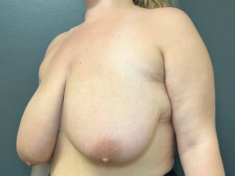Breast Reduction Before & After Gallery - Patient 125639 - Image 7