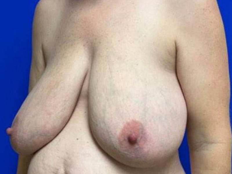 Breast Reduction Before & After Gallery - Patient 101592 - Image 3
