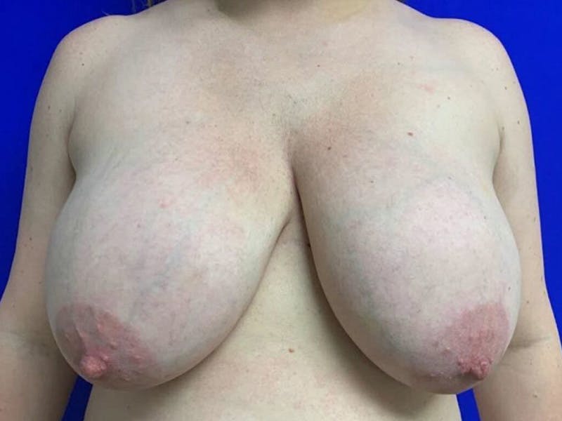 Breast Reduction Before & After Gallery - Patient 191648 - Image 1