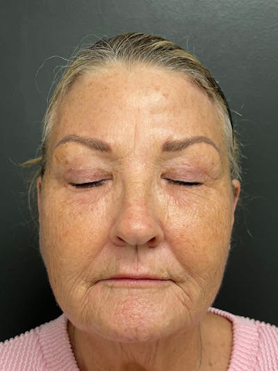 Brow Lift Before & After Gallery - Patient 206709 - Image 2