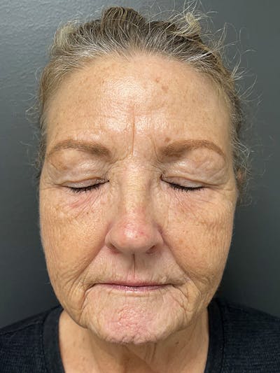 Brow Lift Before & After Gallery - Patient 206709 - Image 1