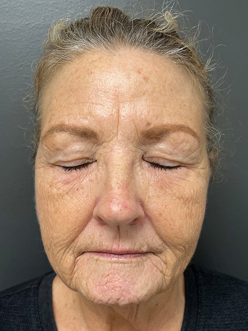 Brow Lift Before & After Gallery - Patient 206709 - Image 1