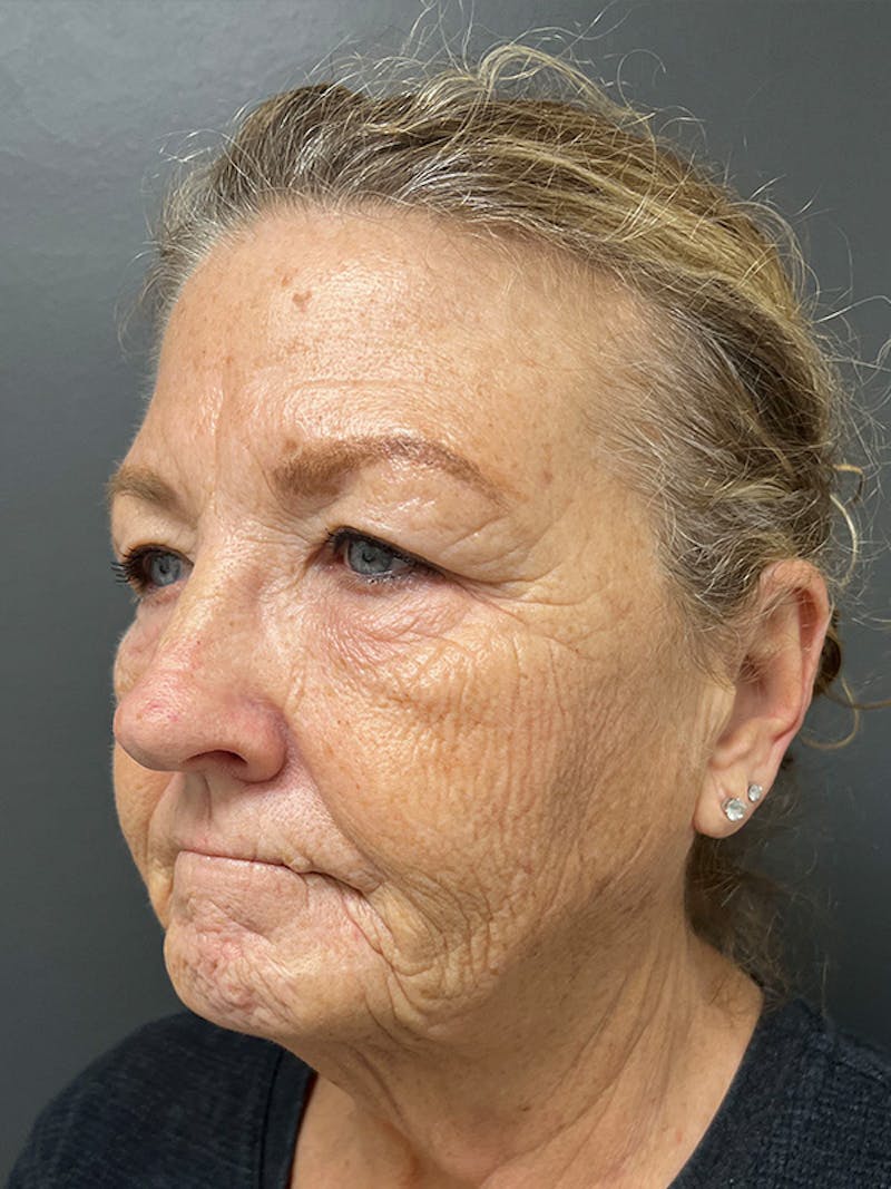 Brow Lift Before & After Gallery - Patient 206709 - Image 7
