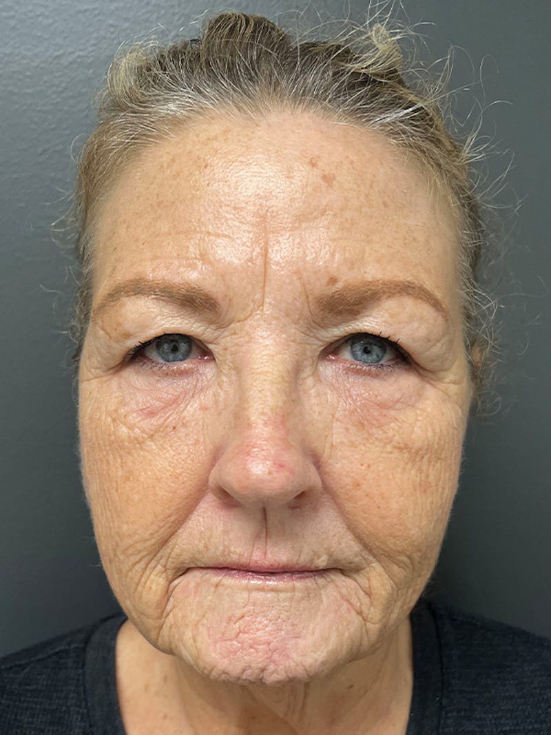 Brow Lift Before & After Gallery - Patient 206709 - Image 3