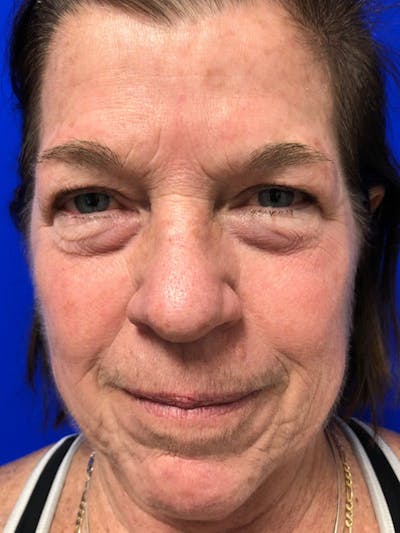 Brow Lift Before & After Gallery - Patient 256609 - Image 1