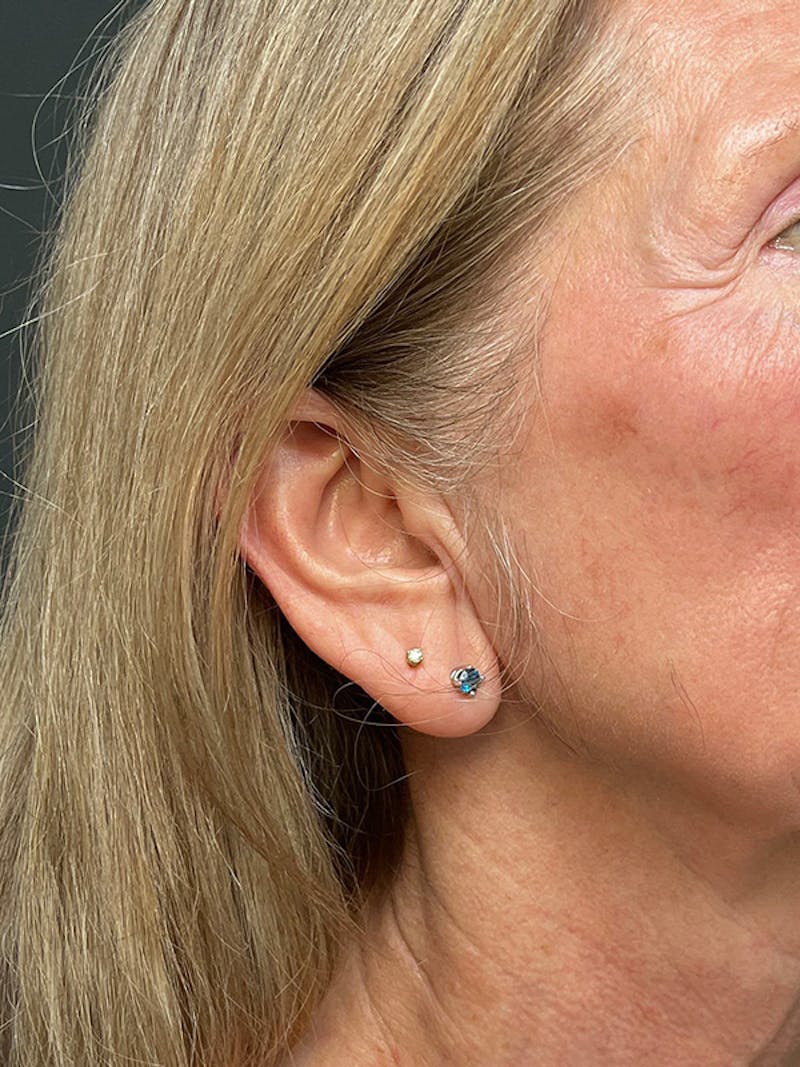Earlobe Repair Before & After Gallery - Patient 298992 - Image 3