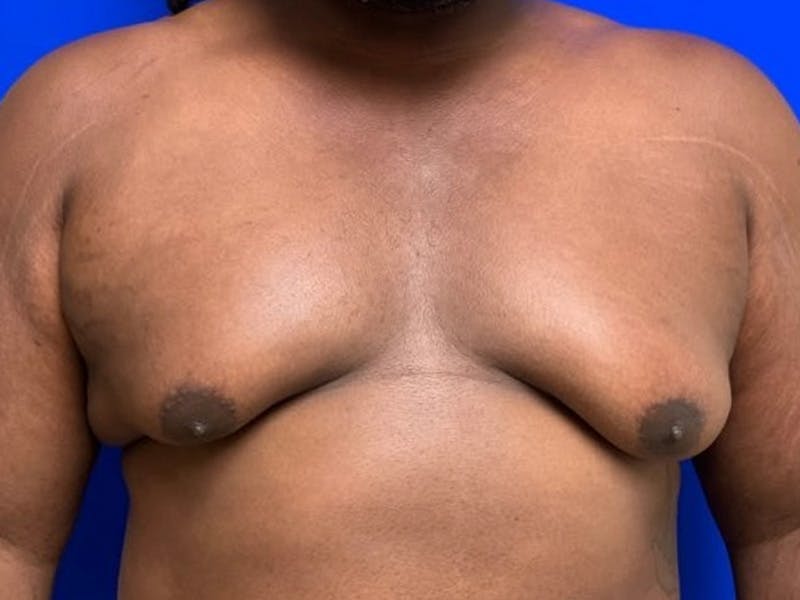 Gynecomastia Before & After Gallery - Patient 150764 - Image 1