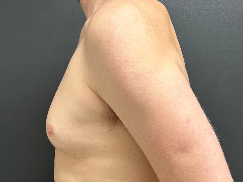 Gynecomastia Before & After Gallery - Patient 376405 - Image 9