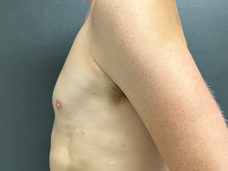Gynecomastia Before & After Gallery - Patient 376405 - Image 10