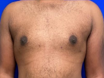 Gynecomastia Before & After Gallery - Patient 265666 - Image 2