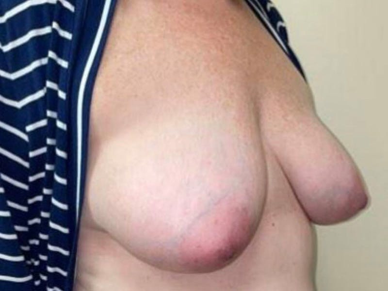 Breast Implant Reconstruction Before & After Gallery - Patient 121284 - Image 3