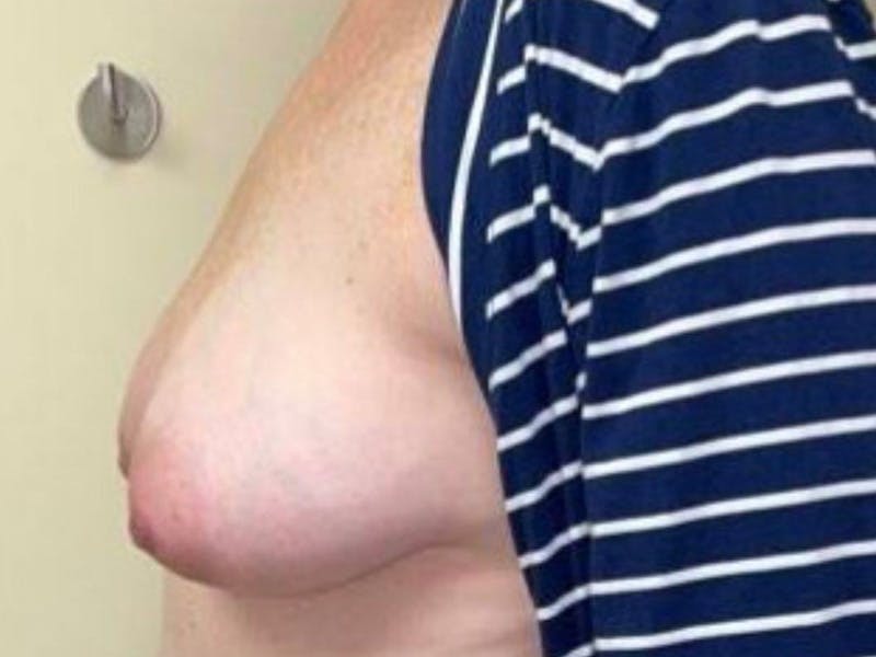 Breast Implant Reconstruction Before & After Gallery - Patient 121284 - Image 9