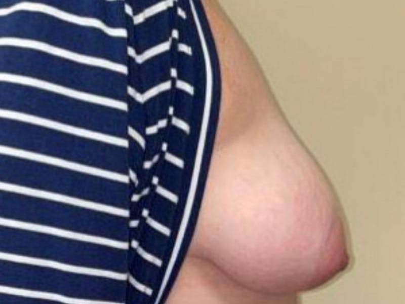 Breast Implant Reconstruction Before & After Gallery - Patient 121284 - Image 5