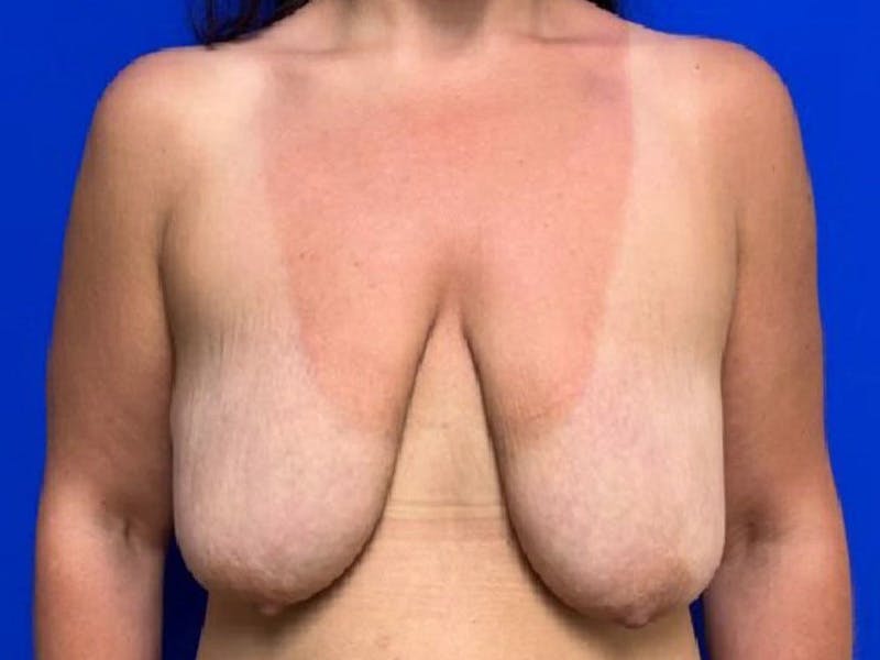 Mastopexy (Breast Lift) Before & After Gallery - Patient 279579 - Image 1