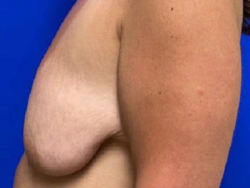 Mastopexy (Breast Lift) Before & After Gallery - Patient 279579 - Image 5