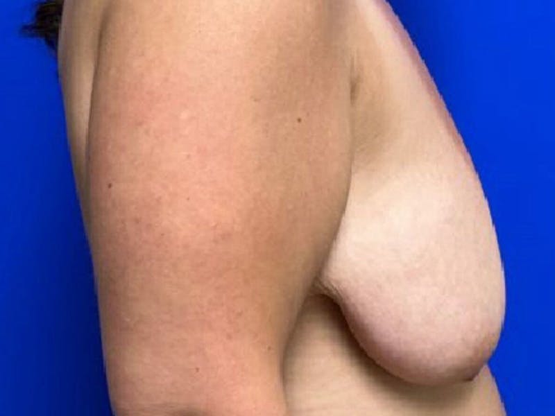 Mastopexy (Breast Lift) Before & After Gallery - Patient 279579 - Image 7