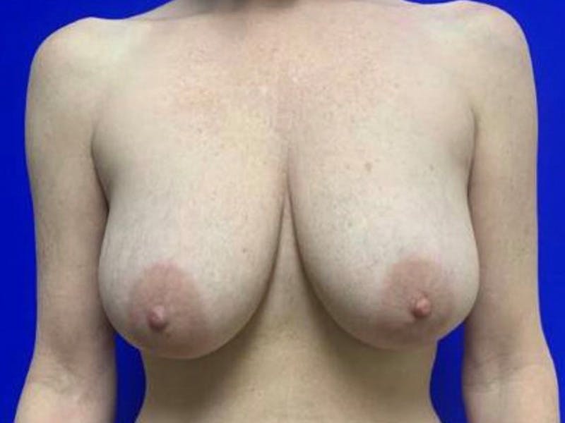 Mastopexy (Breast Lift) Before & After Gallery - Patient 402414 - Image 1