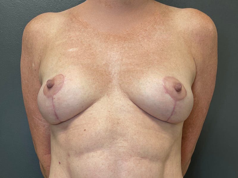 Mastopexy (Breast Lift) Before & After Gallery - Patient 238607 - Image 2