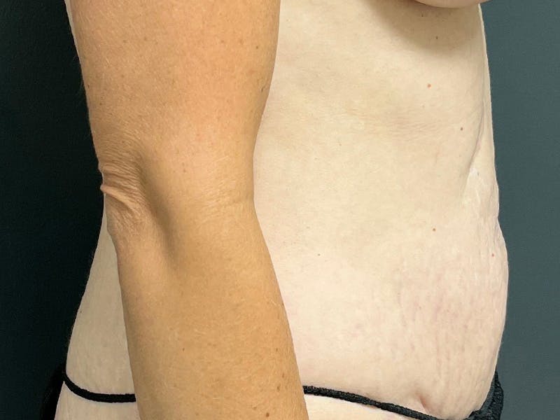 Mini Tummy Tuck Before & After Gallery - Patient 284453 - Image 6