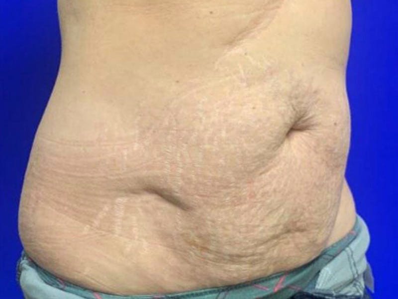 Mini Tummy Tuck Before & After Gallery - Patient 284453 - Image 3