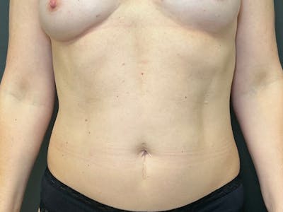 Mini Tummy Tuck Before & After Gallery - Patient 418282 - Image 2