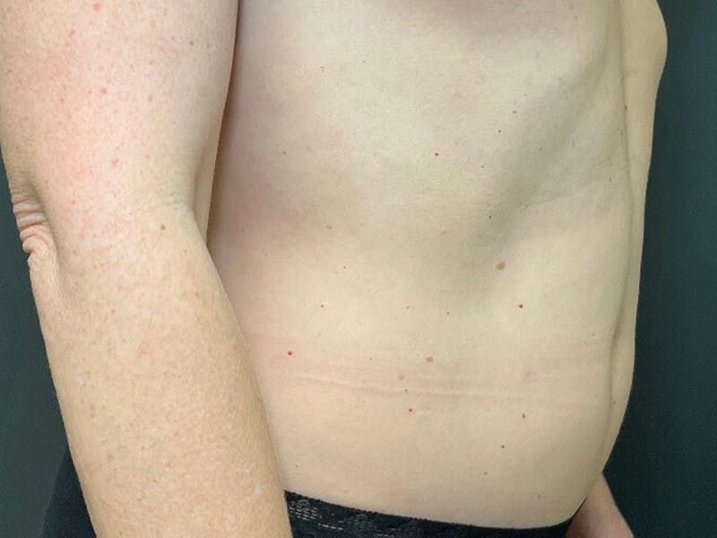 Mini Tummy Tuck Before & After Gallery - Patient 418282 - Image 4